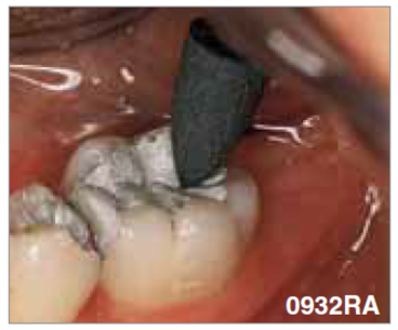 Amalgam reducer