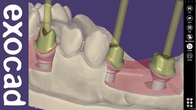 Implant modul